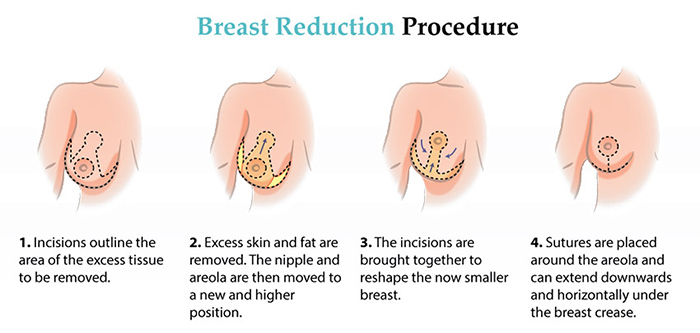 Breast Reduction Surgery- Definition, Need, Preparation, & Recovery -  Pristyn Care