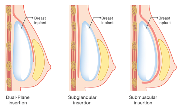 breast implant placement