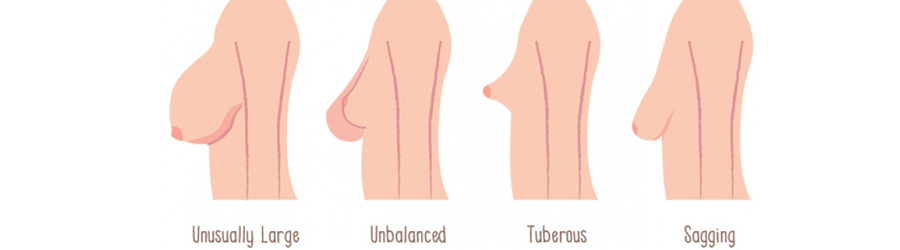 tuberous breasts surgery tunisia