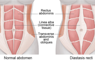 Everything you need to know about Diastasis recti