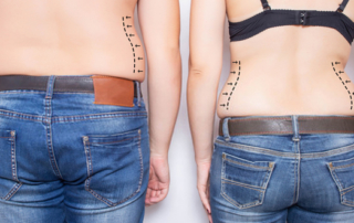 Is liposuction efficient against love handles ?