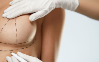 Breast-reduction-augmentation-which-size-the-most-common