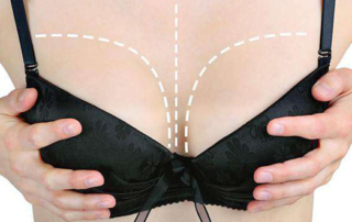 alternative-to-breast-implants