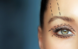 Answering frequently asked questions about blepharoplasty