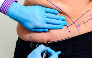 Is tummy tuck a viable option for you ?