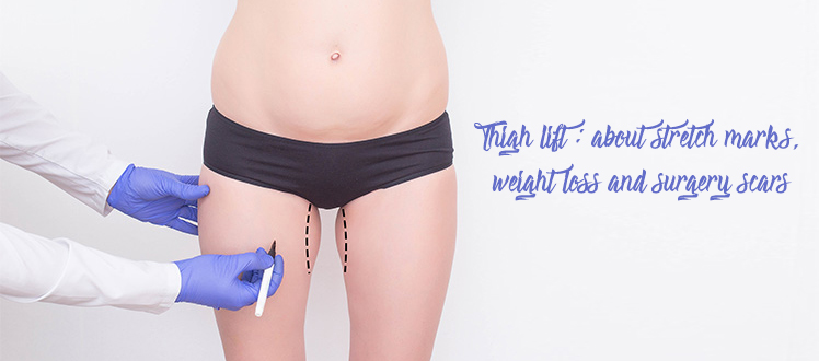 Where Are the Scars for a Thigh Lift?
